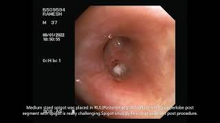 Placement of Endobronchial spigot in a patient with Persistent Air Leak PAL [upl. by Ayian101]