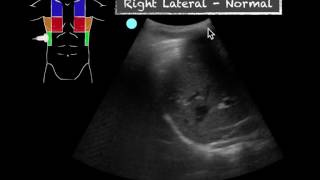 POCUS  Teaching Point  Ultrasound vs CXR in pneumonia [upl. by Vookles107]