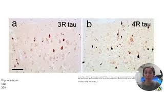 Neuropathology  Part 2 [upl. by Oicatsana]