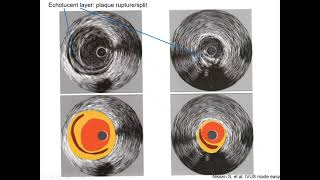 Intravascular ultrasound IVUS  Elias Hanna Univ of Iowa [upl. by Falo966]