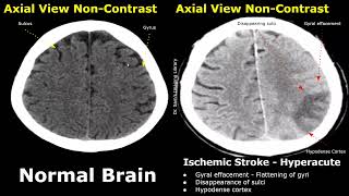 CT Scan Brain Normal Vs Ischemic Stroke Images  NonContrast HyperacuteAcuteChronic Infarction [upl. by Diva769]