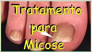 🔴Tratamento para Micose  Dicas do Marido [upl. by Ezarra]