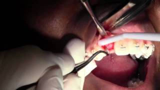 Implant Placement 7 Site NB Replace Flap Design amp Pilot Hole [upl. by Suiravad529]