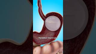 How a Gastric Balloon Helps with Weight Loss 😮  shorts viralvideo  Creativelearning3d [upl. by Nosille196]