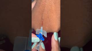 IV cannula kaise lagate hain  IV CANNULATION shorts viral trending [upl. by Arrehs]