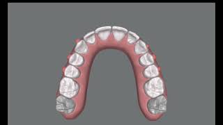 Simple alignment with Invisalign clincheck project ready to send to the patient [upl. by Anaahs]