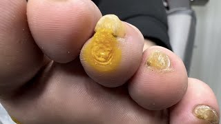 Removal of Multiple Warts and Calluses [upl. by Nauqel]