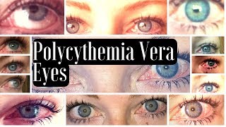 MPN Polycythemia Vera Blood Shot Red Eye Manifestations [upl. by Edholm]