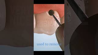 Fixing a Gum line Cavity short dentist teethwhitener [upl. by Deroo]