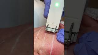 Profound RF Microneedling [upl. by Valenza]