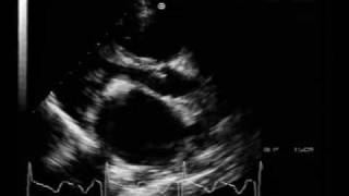 MS different aspectscalcified mitral stenosis [upl. by Bechler]