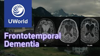 Frontotemporal Dementia vs Alzheimer Disease with Histology  UWorld USMLE MBBS [upl. by Fergus]