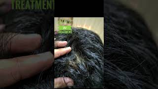 Case of Alopecia areata cure with homoeopathic medicine homoeopathy holistichealth india [upl. by Yenor]