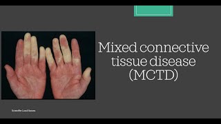 MCTD Mixed Connective Tissue Disease Essential medicine [upl. by Ardnaiek212]