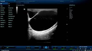 Multiple Epididymal cysts  Diagnostic ultrasound cases [upl. by Ymas]