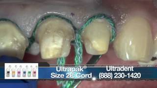 Replacing Crowns on Teeth 710 With BruxZir® Anterior [upl. by Thevenot]