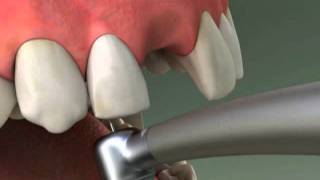 Dentist  Maryland Bridge Procedure [upl. by Yecam]