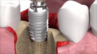 SIC invent Dental Implant Procedure SICmax implant insertion [upl. by Odelle]