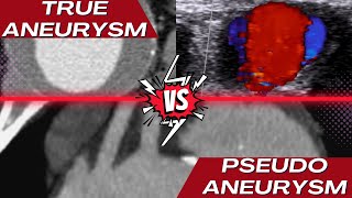 True Aneurysm vs Pseudoaneurysm [upl. by Gula]