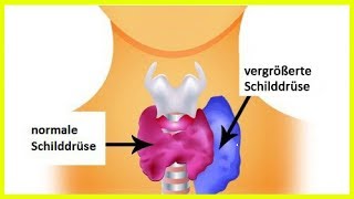 Hyperthyreose bei Frauen Symptome und empfohlene Nahrungsmittel [upl. by Broderic]