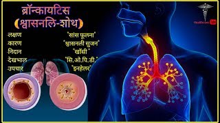 ब्रॉन्काइटिस श्वासनली–शोथ  सांस फूलना  फेफड़ों में वायु प्रवाह अवरुद्ध amp क्षतिग्रस्त होना [upl. by Paff]