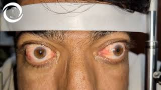 Thyroid Ophthalmopathy Sight Threatening Complications [upl. by Otes]