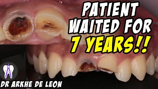 Amazing Case of Fractured Teeth Restored with Zirconia Crown 4k C29 [upl. by Dnalro54]