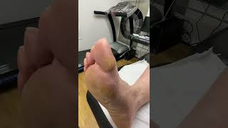 Discover how an Australian podiatrist tackles thick toe calluses PodiatryWonders FootHealth [upl. by Sadnak]