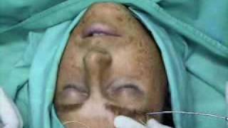 brow lift one side by Serdev sutures no incisions no scars serdevgmailcom [upl. by Novek846]