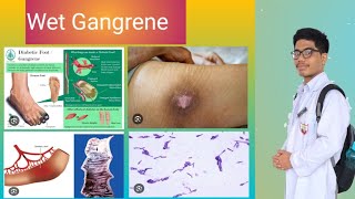 Wet Gangrene Pathology Why Moist Tissues Affected [upl. by Dasa]