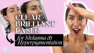 I Tried the Clear  Brilliant Laser for Hyperpigmentation and Melasma  REBELLE NUTRITION [upl. by Clarkson]