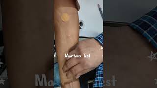 Mantoux Test  Tuberculin Skin Test  TBTest infectionBodyMTBPCRTBGOLD [upl. by Leinoto]