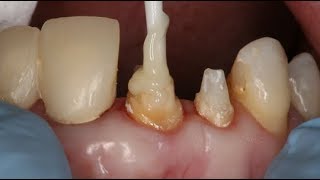 Dental Core Build Up and Post Cementation  Dental Online Training [upl. by Hanikas]