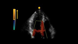 What is tissue Doppler and speckle tracking in echocardiography [upl. by Beane]