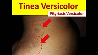 Tinea Versicolor in Young People  Pityriasis Versicolor [upl. by Warfold591]