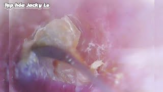 Ear Wax Removal 178 Ear fungus is very itchy  Ear Cleaning ASMR [upl. by Sirkin]