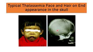 Beta Thalassemia and Alpha Thalassemia  Types Diagnosis and Treatment  Thalassemia Major amp Minor [upl. by Lupe154]