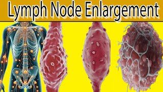 Lymph Node Enlargement  7 Most common causes [upl. by Yliah193]