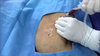 Ultrasound Guided Axillary vein Catheterization [upl. by Atil960]