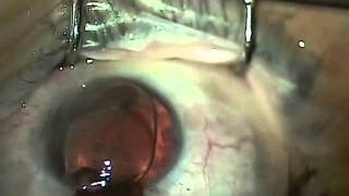 Artificial iris brightocular Aniridia surgery [upl. by Nagek]