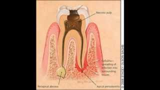 Granuloma apical Definición [upl. by Abbotson]