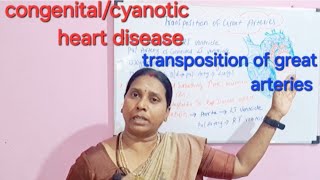 congenitalcyanotic transposition of great arteriesclass in tamil [upl. by Grishilde]