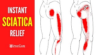 How to Instantly Fix Sciatica Pain [upl. by Bowes]