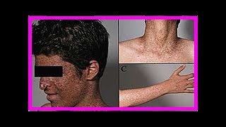 Xeroderma pigmentosum was es ist Symptome und wie die Behandlung ist [upl. by Sobmalarah]