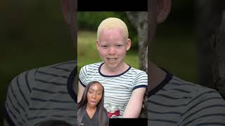 Albinism Understanding the Genetic Condition and Its Impact [upl. by Fokos]