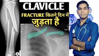 कंप्लीट clavicle Fracture info bone fracture kitne din me thik hota hai haddi kitne din me judti h [upl. by Coheman]