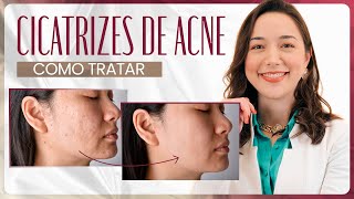 Como tratar as CICATRIZES DE ACNE  Com Dra Marina Hayashida [upl. by Ahsiekal]