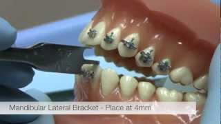 American Orthodontics Alexander LTS Brackets  Bracket Placement Video [upl. by Tnomal]