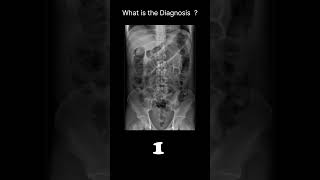 Posttraumatic ileus Abdominal Xray Abnormalities Postoperative ileus 67 radiologychannel007 [upl. by Anaile]