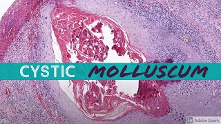 Molluscum Contagiosum cystic 5Minute Pathology Pearls [upl. by Dorej742]